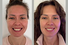 Botox  Верхняя треть. Мезотерапия для коррекции розацеа, акне, яркости сосудов